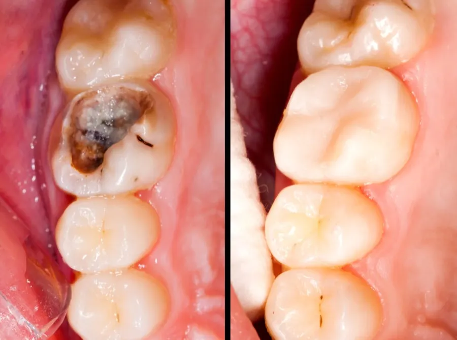 A tooth with decay before, and the finished ceramic restoration after