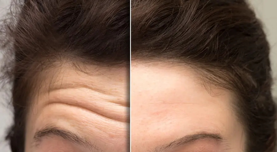 Forehead lines before and after Botox