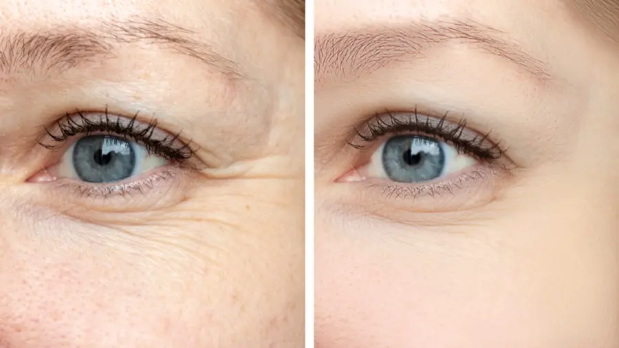 Eyes before and after Botox