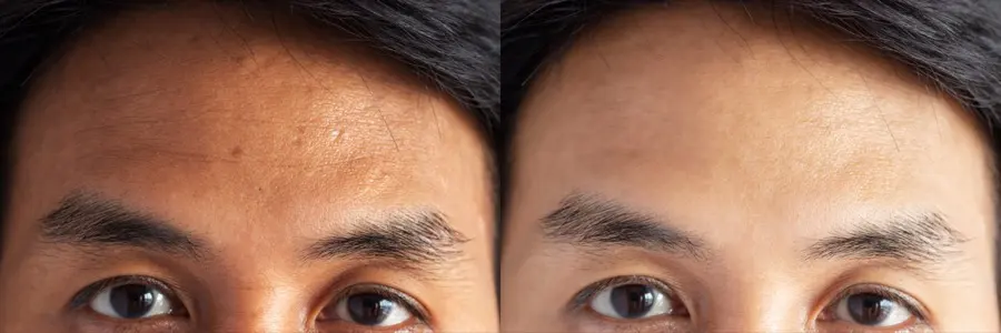 Brow before and after Botox