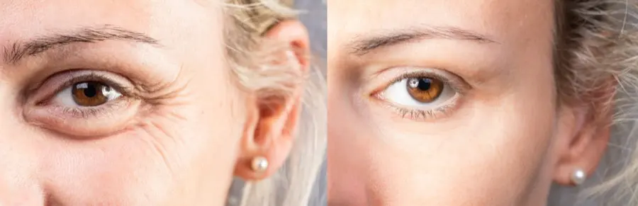 Eyes before and after Botox