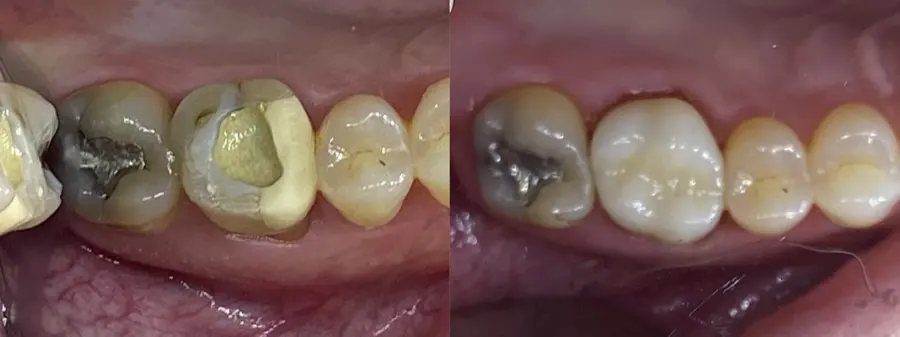 Old filling before and new crown after
