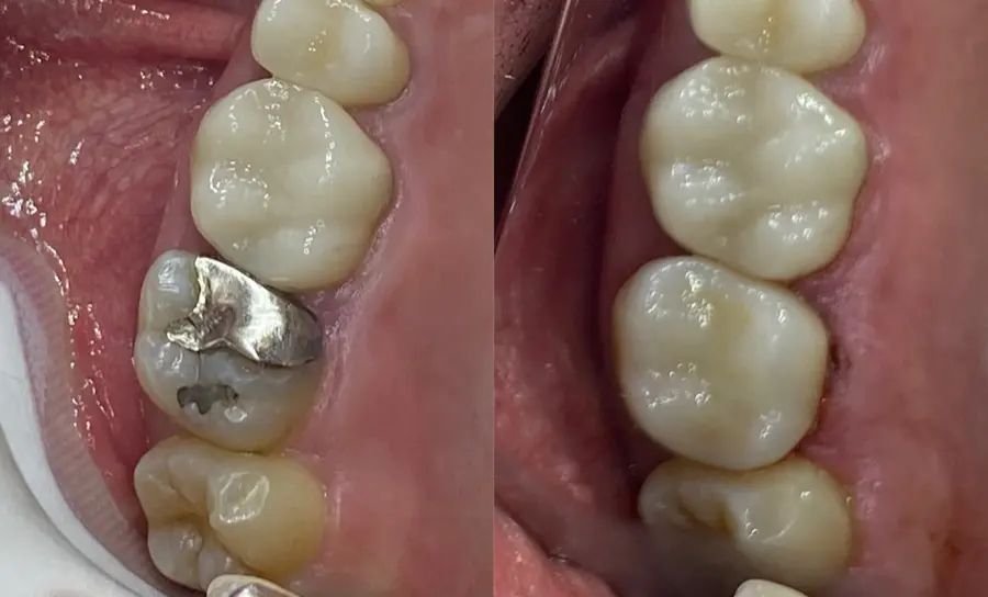 Metal-filled molar before and ceramic crown after
