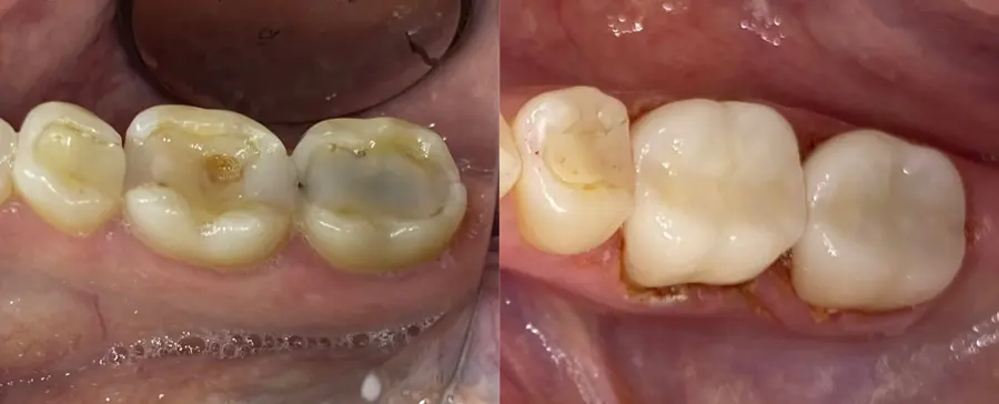Decayed molars before and restored after