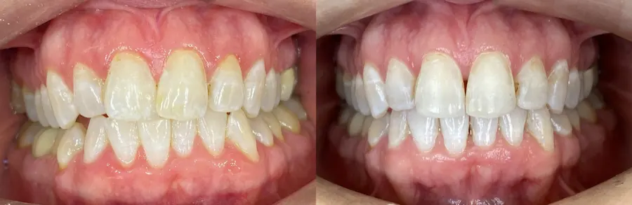 Invisalign before and after