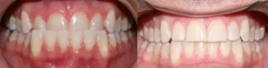 Invisalign before and after