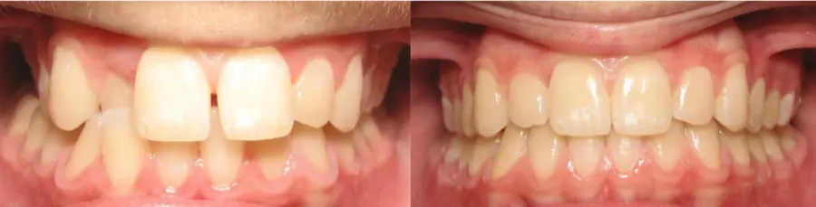 Invisalign before and after