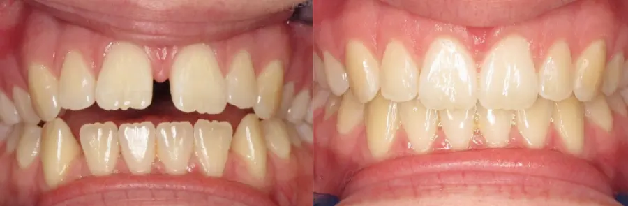 Gap in front teeth closed with Invisalign