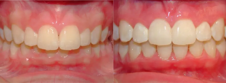 Invisalign before and after