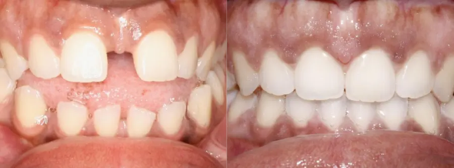 Gap in front teeth closed with Invisalign