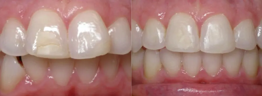 Invisalign before and after