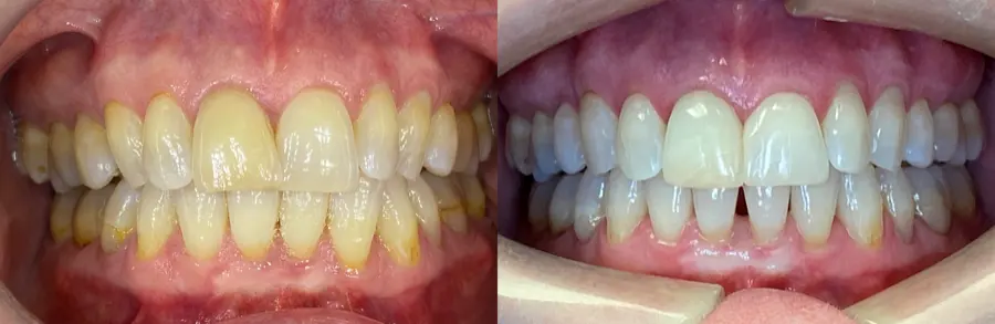 Invisalign before and after