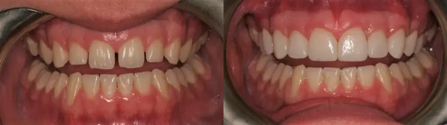 Veneers before and after