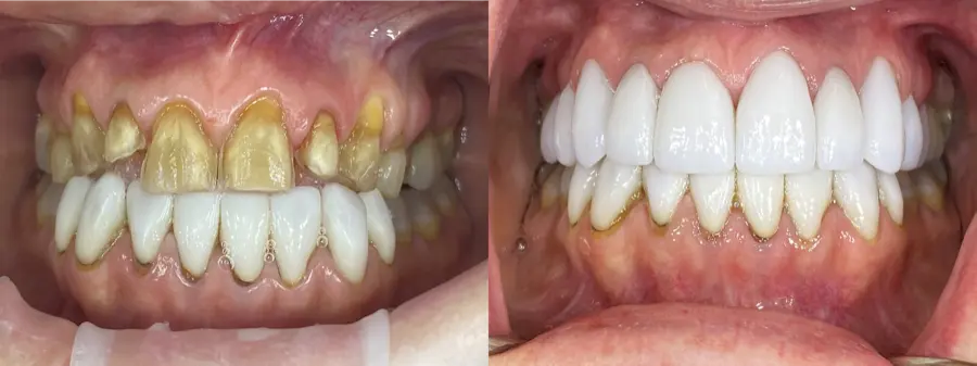 Stained front teeth before and bright veneers after