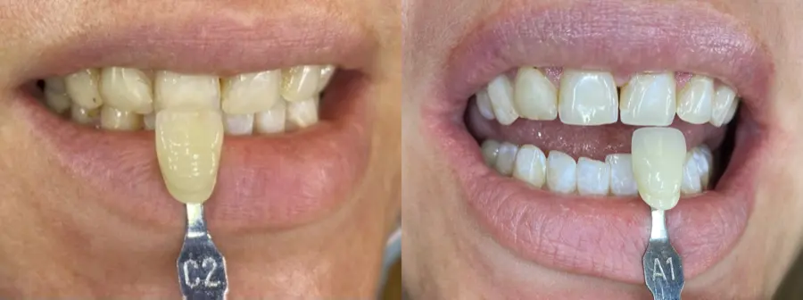 Whitening shade comparison before and after