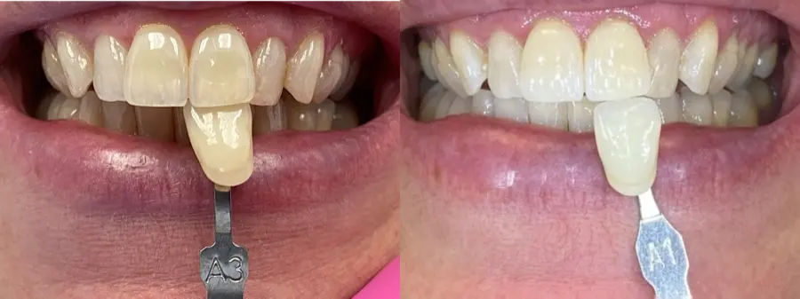Whitening shade comparison before and after