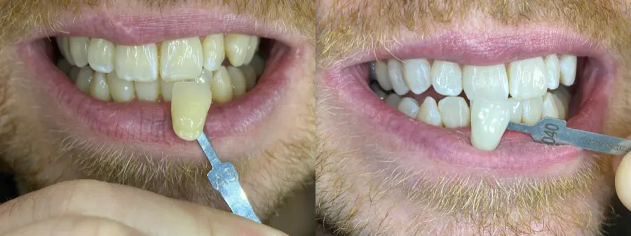 Whitening shade comparison before and after