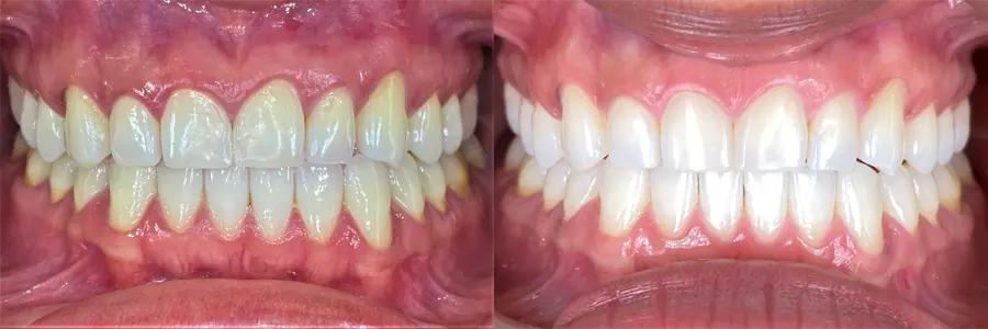 Teeth before and after whitening