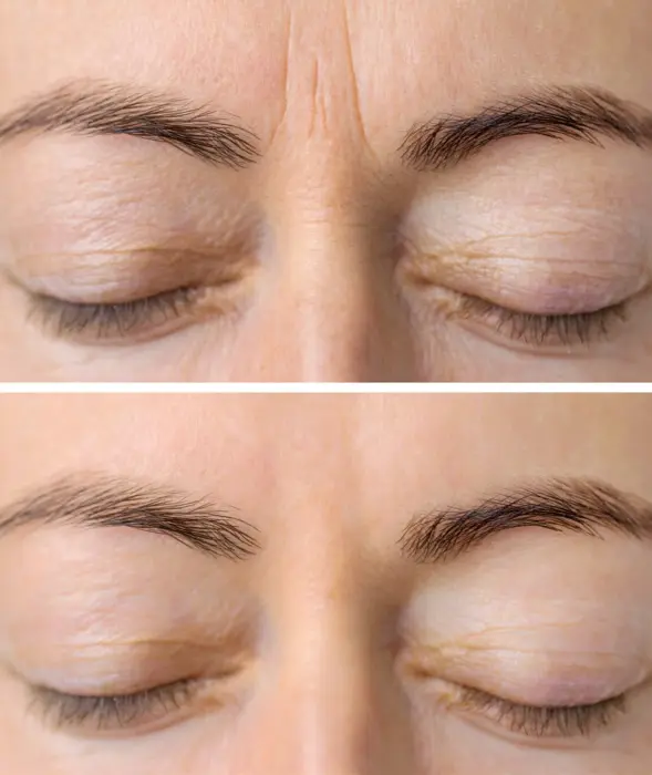 Eyes before and after Botox treatment