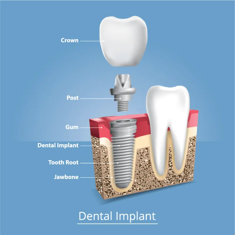 Diagram of a dental implant showing crown, abutment and root