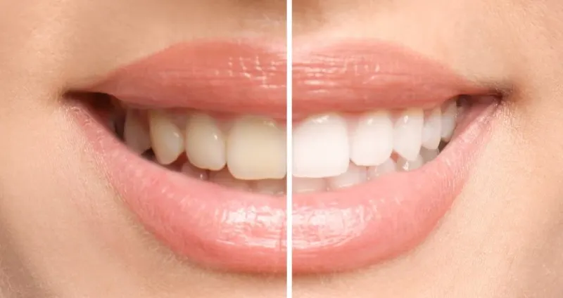 Smile before and after professional whitening